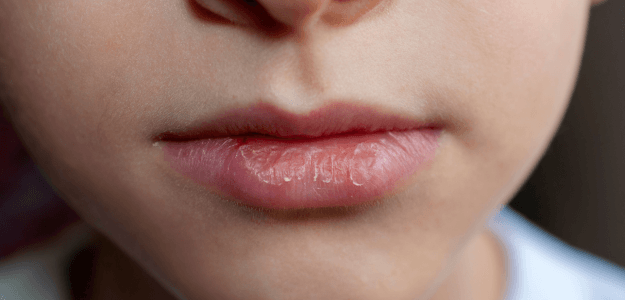 labios secos
